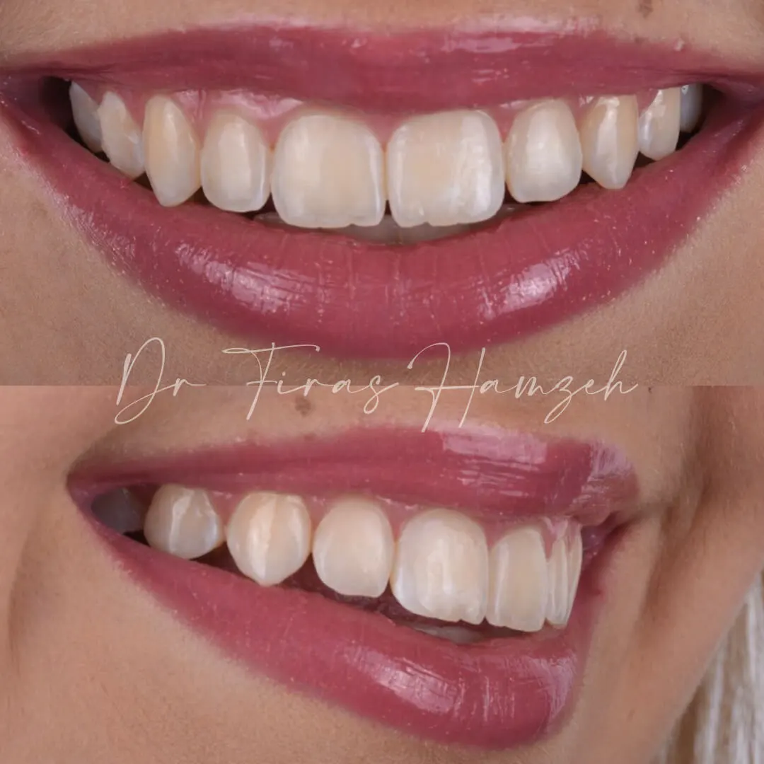 Before and after orthodontic case 4