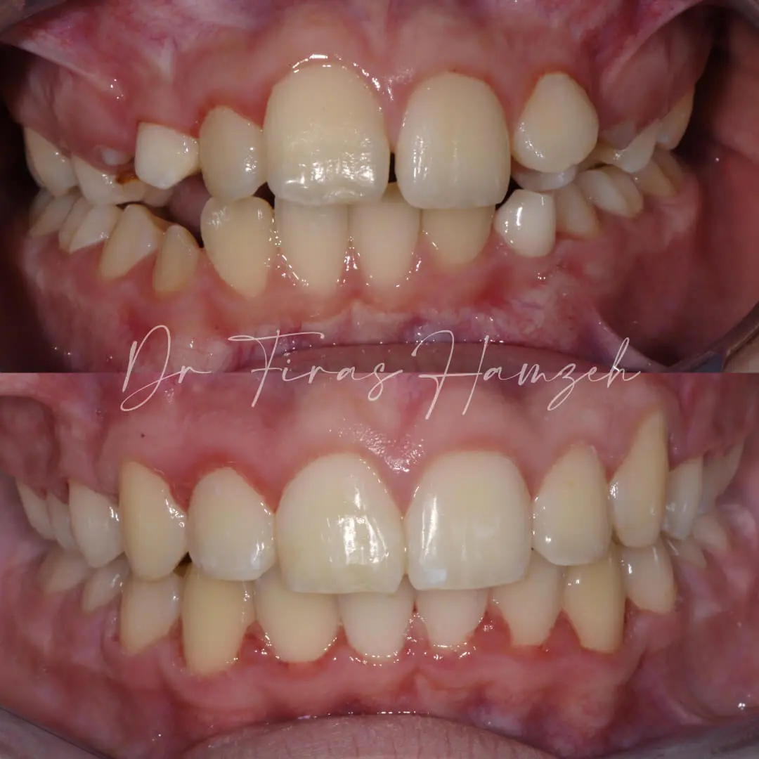 Before and after orthodontic case 8