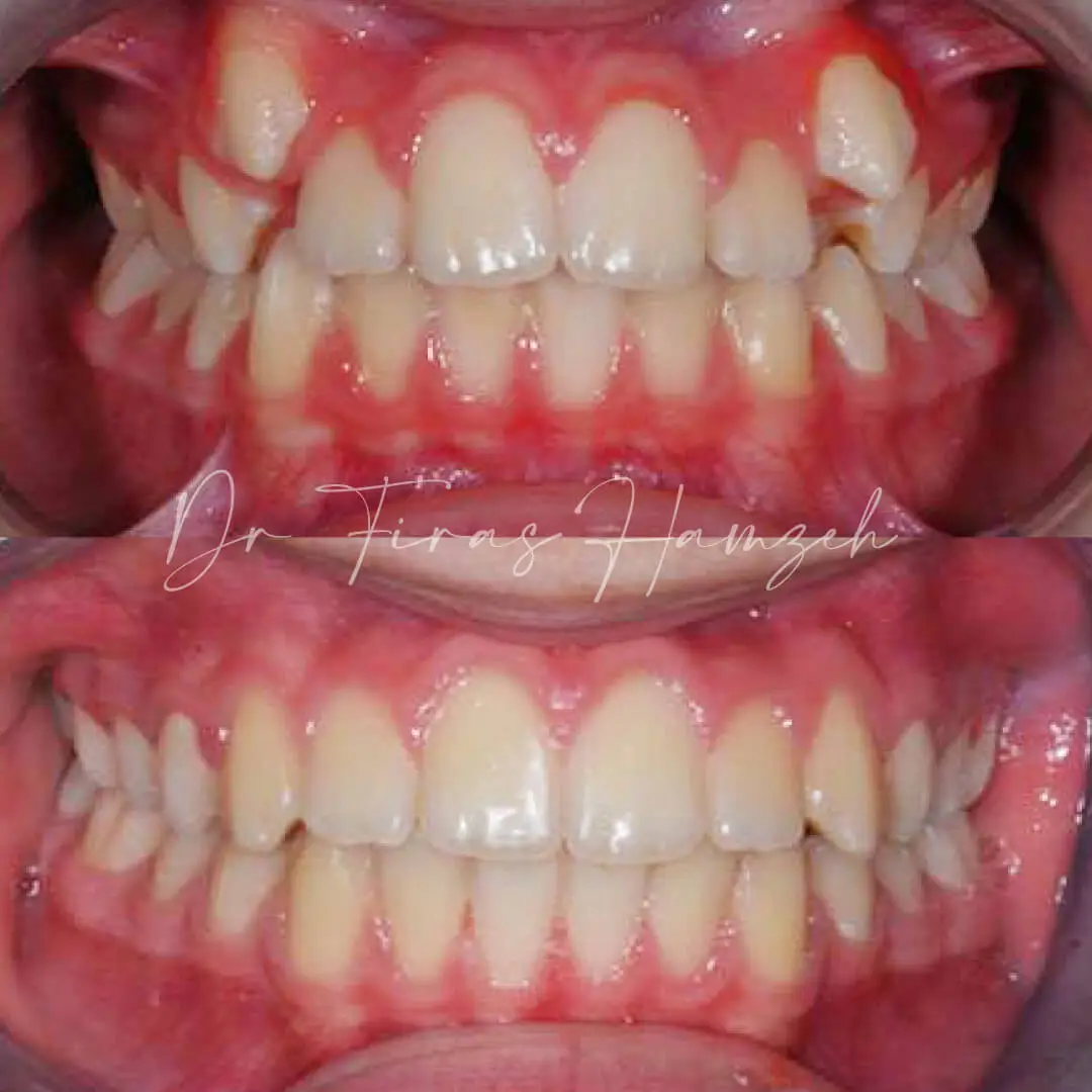 Before and after orthodontic case 9